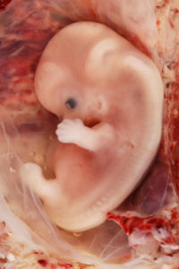 Photograph of -Week Human Embryo from Ectopic Pregnancy