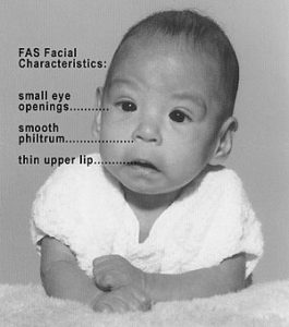 Imagen de un bebé con características faciales FAS de pequeñas aberturas oculares, un filtro liso y un labio superior delgado.