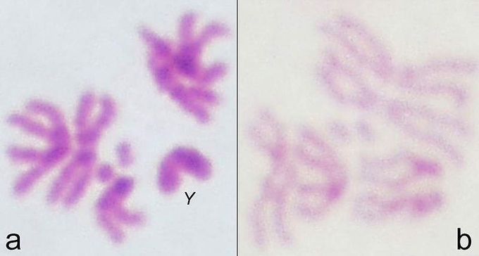 Microfotografías lado a lado de cromosomas humanos con foto a la izquierda incluyendo una imagen de un cromosoma Y.