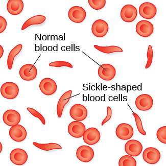 A drawing of normal red blood cells which are circular, with several abnormal sickle-shaped blood cells scattered among them.