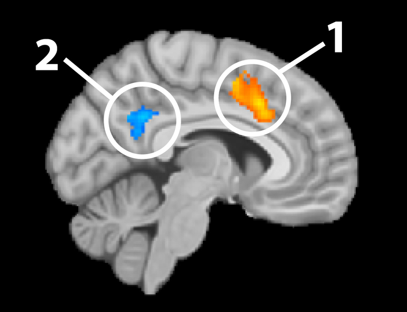 Imagen de FMRI muestra aumento de la actividad en el lóbulo frontal y disminución de la actividad en el lóbulo parietal.