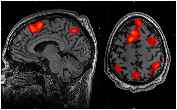 Un escaneo de un cerebro humano. Algunas secciones del cerebro están iluminadas en rojo.