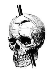 Un cráneo con una barra que perfora hacia abajo a través de la parte superior de la cabeza y a través de la mandíbula.