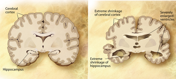 En un cerebro con Alzheimer, la corteza cerebral y el hipocampo se contraen y los ventrículos se agrandan.