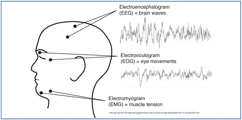 vista lateral de la cabeza con puntos EEG (cabeza), EOG (ojos) y EMG (barbilla/mandíbula) y ondas correspondientes