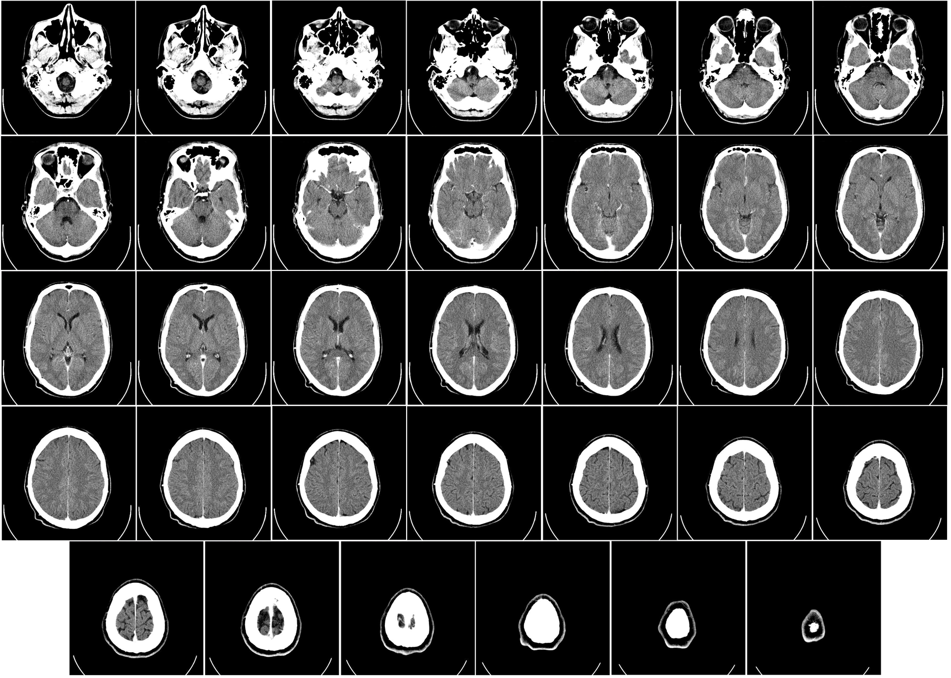 Imágenes de una tomografía computarizada de un cerebro.