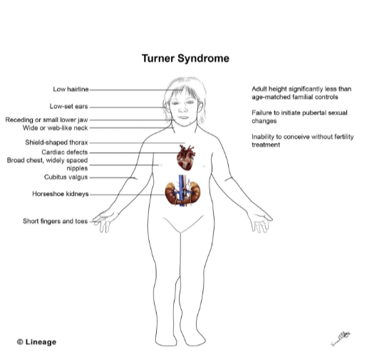 Dibujo de una niña con síndrome de Turner que muestra muchas anomalías físicas; algunas aparecen listadas en el texto