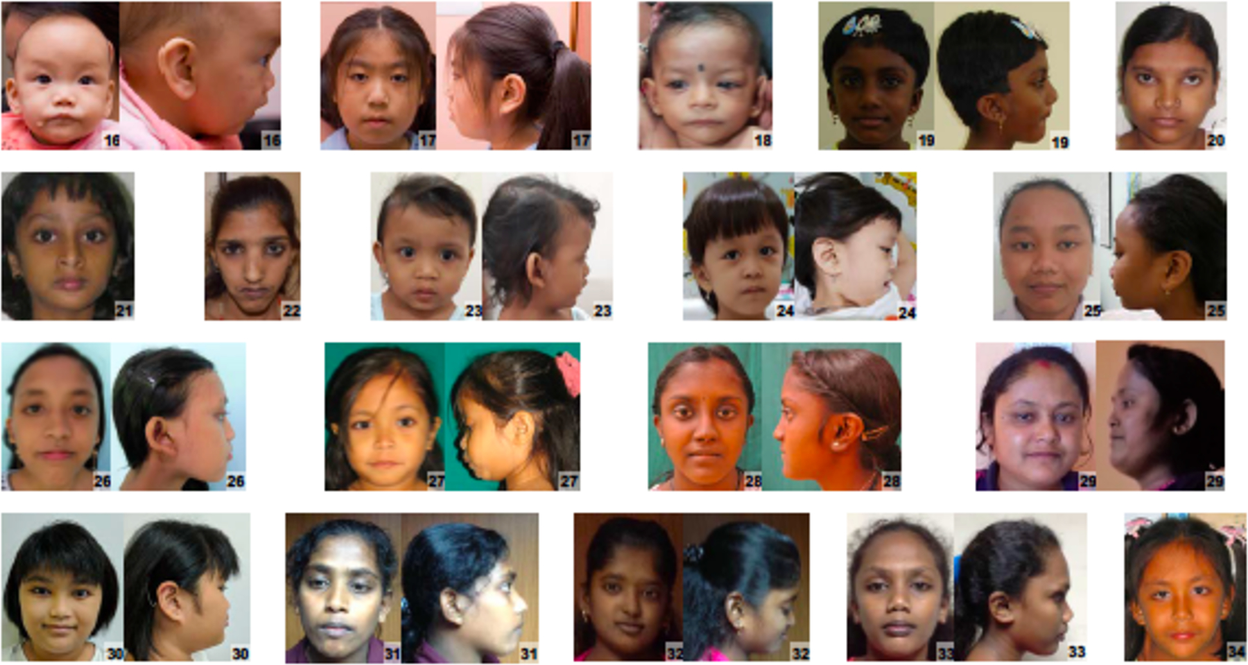 Fotos de 19 niñas y mujeres de ascendencia asiática que tienen síndrome de Turner