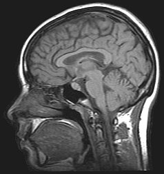 cerebro humano representado por fMRI