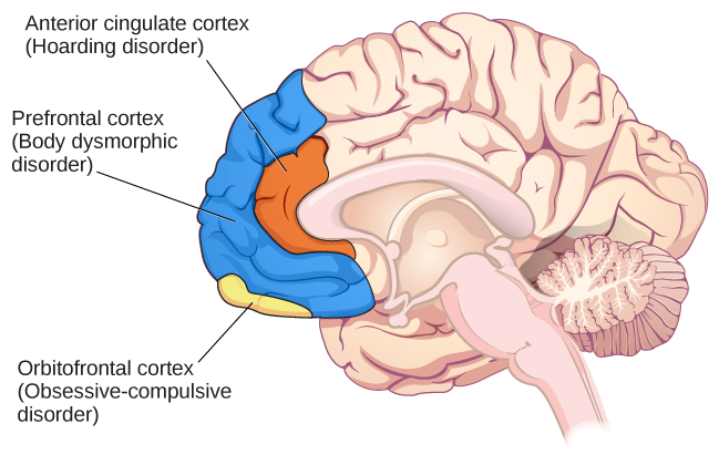 An illustration of the brain identifies the location of three areas and their associated disorders: the anterior cingulate cortex (hoarding disorder), the prefrontal cortex (body dysmorphic disorder), and the orbitofrontal cortex (obsessive-compulsive disorder).