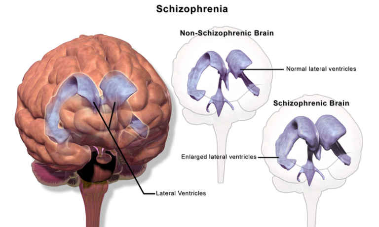 Image of the brain showing enlarged ventricles in a schizophrenic brain.