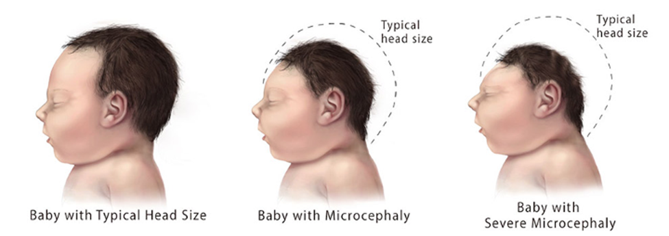 Typical head size, compared to babies with microcephaly and severe microcephaly