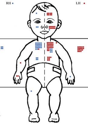 Frequency of touches by area for one infant. In order of frequency least to greatest. Right hand touches left forehead, stomach, check and chest. Left hand touches forehead stomach, check and chest. The frequency of right hand touches is significantly greater than left hand touches. 