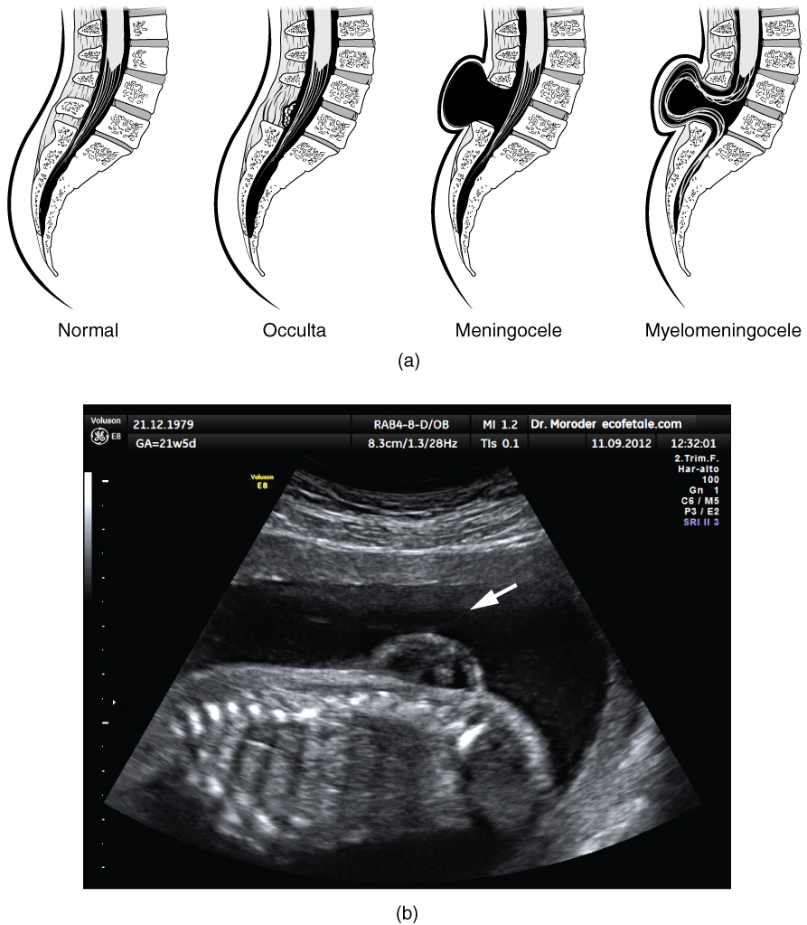 Dibujos de normal + 3 clases de espina bífida (descritas en el texto); ecografía que muestra feto con mielomeningocele