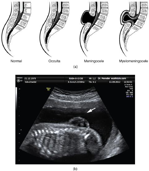 Drawings of normal + 3 classes of spina bifida (described in the text); ultrasound showing fetus with myelomeningocele