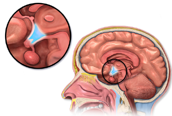 Drawing of a midsagittal section through a human head with the hypothalamus circled and enlarged