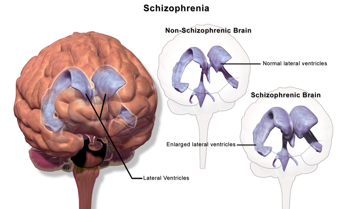 Schizophrenia_(Brain).png