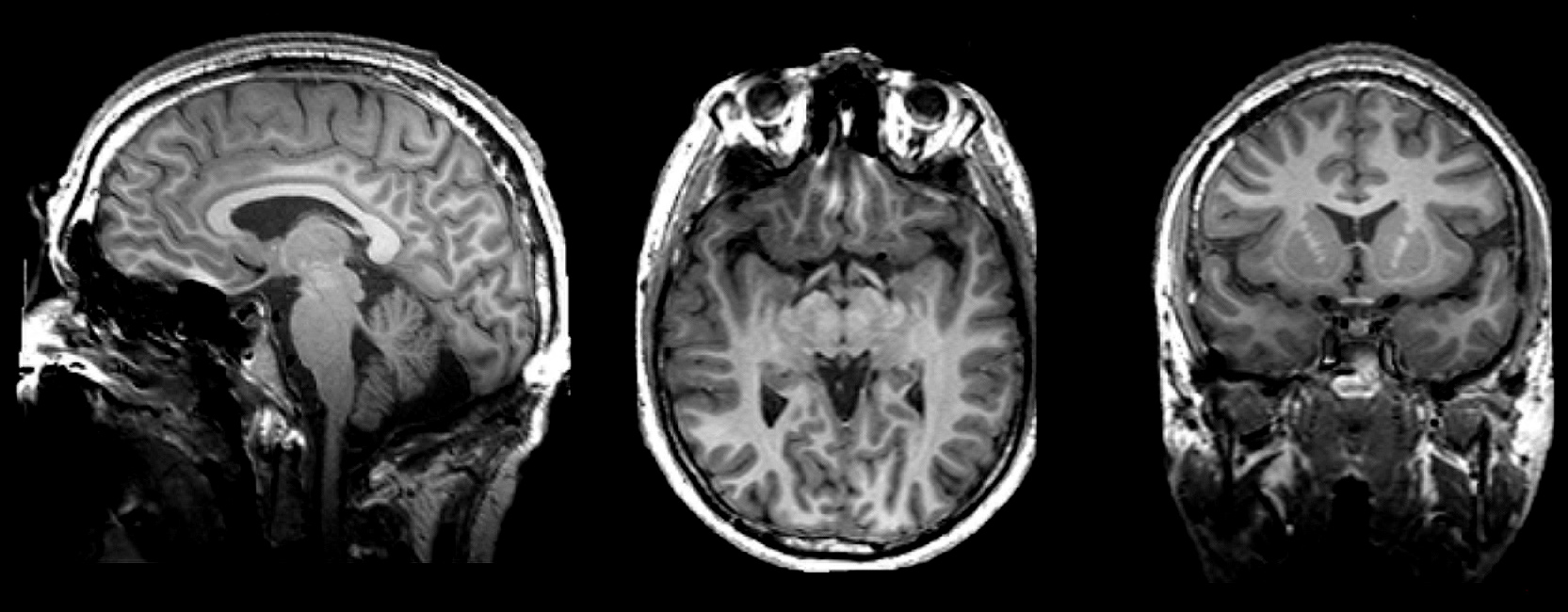 MRI estructural del cerebro