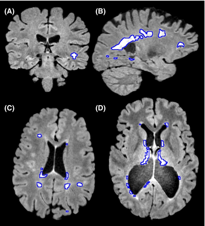 MRI images showing white hyperintensities in different areas of the brain of an individual experiencing symptoms of multiple sclerosis.