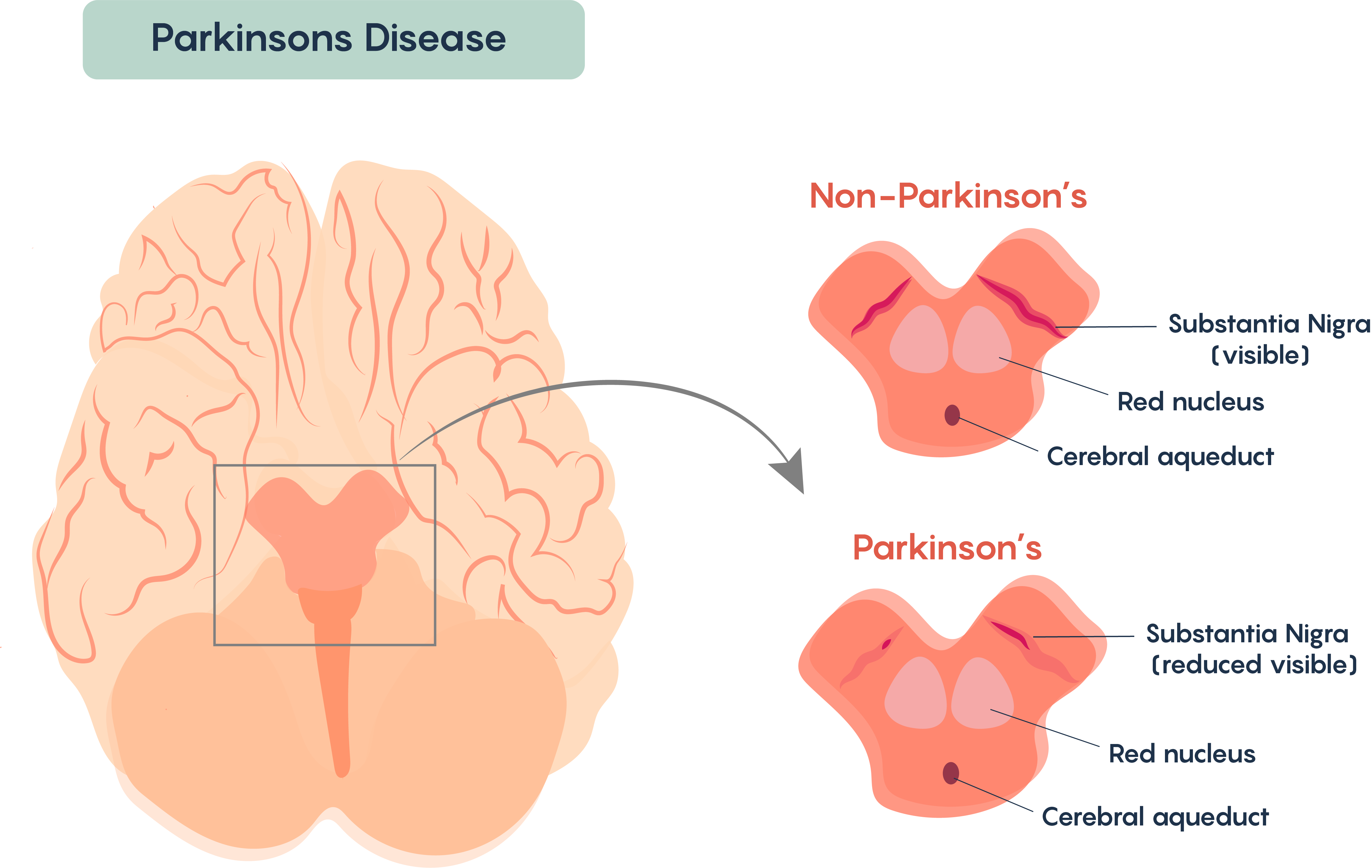 Pérdida de las neuronas dopaminérgicas pigmentadas dentro de la Sustancia Nigra de individuos con Enfermedad de Parkinson.
