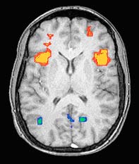 Functional MRI image of human brain from above shows activation in the frontal cortex during a working memory task.