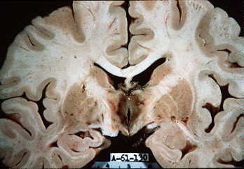 Photo of a human brain from a cadaver cut to show discolored tissue around 3rd ventricle; intact corpus callosum is above.