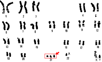 Dibujo que muestra cromosomas humanos incluyendo la anomalía cromosómica en el vigésimo primer cromosoma, trisomía 21.