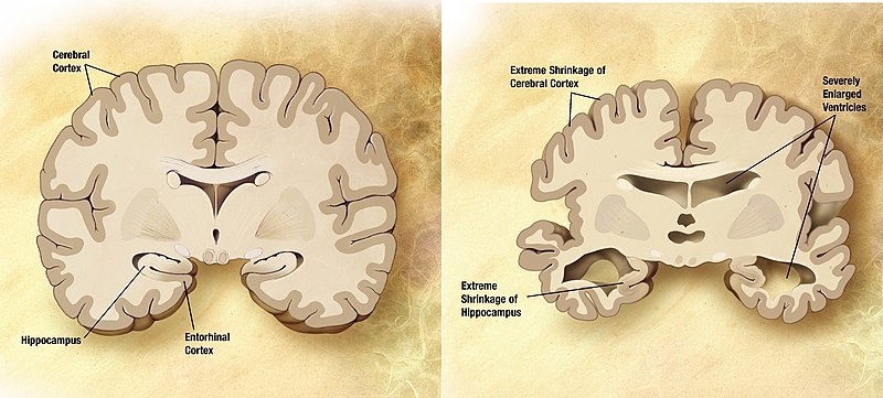 Dos dibujos comparando cerebros de una persona sana con uno con enfermedad de Alzheimer mostrando pérdida de tejido. Ver texto.
