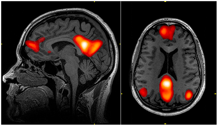 Brain images showing locations of default mode network and compared to locations of task-related network.  See text.