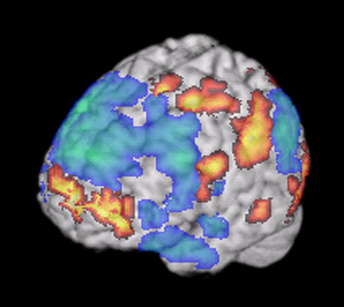 Imagen de fMRI que muestra la activación cerebral durante la improvisación creativa por músicos de jazz Ver texto.