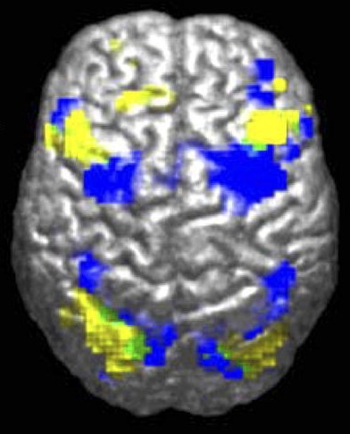 Imagen de un cerebro humano desde arriba mostrando diferentes patrones de activación en persona con autismo y en persona sin autismo.