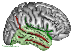 Image of left hemisphere showing temporal lobe gyri.  See text.