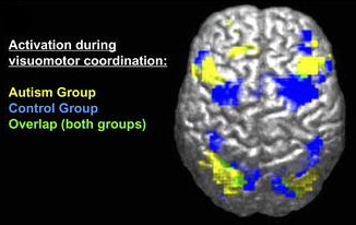 Imagen derivada de FMRI de diferencia entre cerebros de grupos autistas y control. “Activación durante la coordinación visuomotora”.